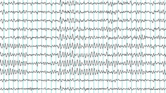 Electroencephalogram (eeg): What is it and How is it Used?