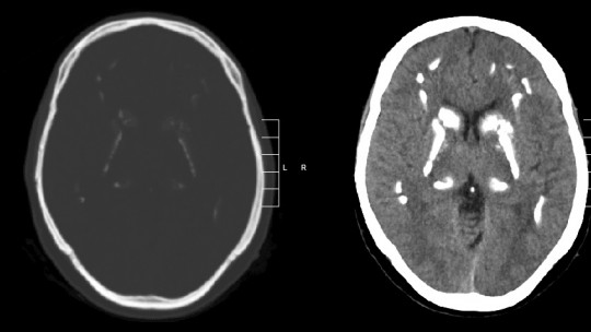 Fahr's Disease: What it Is, Causes and Main Symptoms