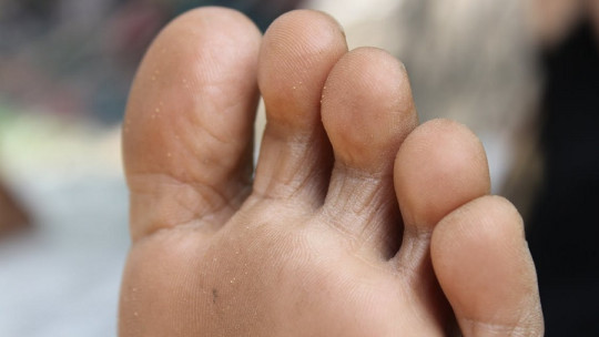 Foot fungus