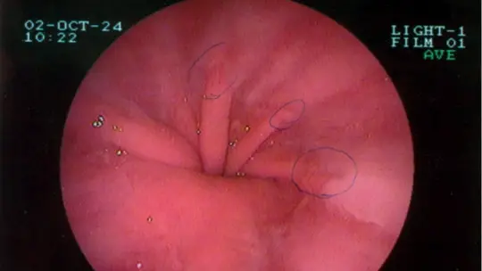 Hiatal hernia types symptoms causes and treatment