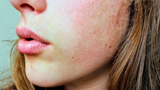 How to Remove Acne Scars: 8 Tips