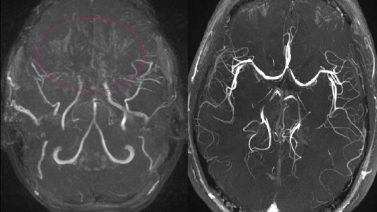 Moyamoya Disease: Symptoms, Causes and Treatment