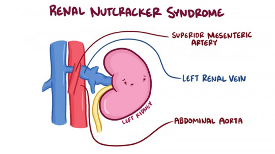 Nutcracker syndrome