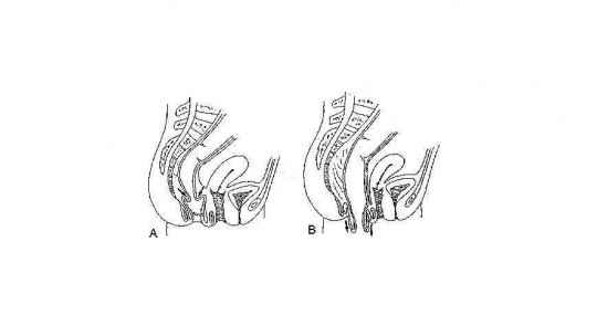 Rectal prolapse