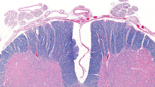 The 2 Types of Myelitis: Symptoms, Causes and Treatment