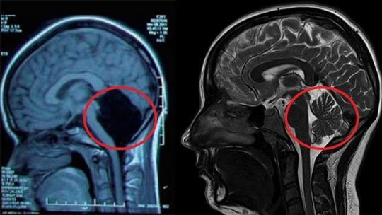 The Unusual Case of a Woman Without a Cerebellum That