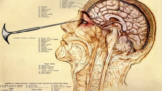 ​what is a Lobotomy and for What Purpose Was it