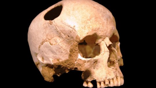 Trepanations: why did our ancestors drill their skulls?