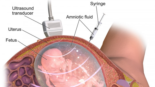 Amniocentesis: What it is and How This Diagnostic Test is