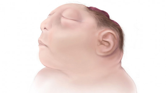 Anencephaly: Causes, Symptoms and Prevention