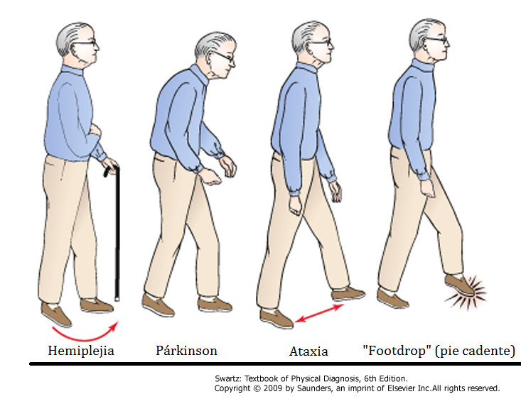 Ways of walking according to the underlying neurological disorder.