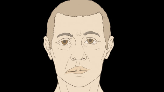 Bell's Palsy: Symptoms, Causes and Treatment