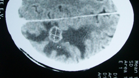 Cerebral edema.