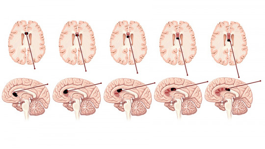 Callosotomy: What it Is, Phases, Usefulness and Associated Risks