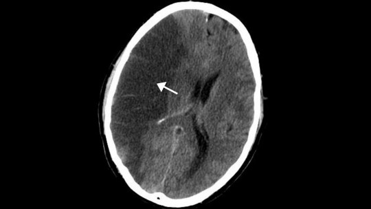 Cerebral ischemia