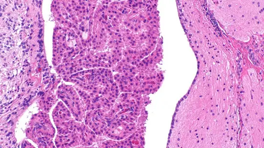 Choroid Plexus: Anatomy, Functions and Pathologies Choroid Plexus: Anatomy, Functions and Pathologies