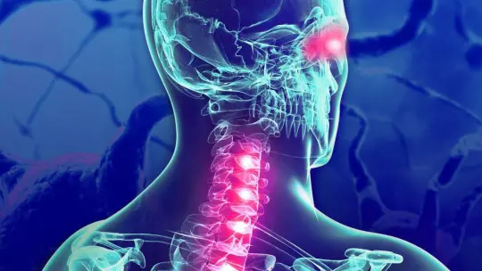 Cognitive impairment due to Multiple Sclerosis