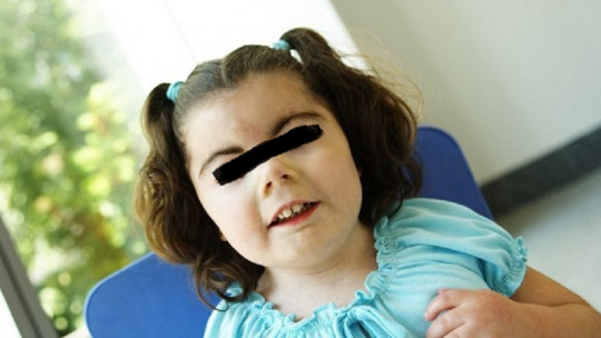 Girl with Cornelia de Lange syndrome