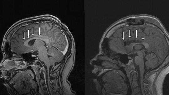 Corpus callosum disconnection syndrome