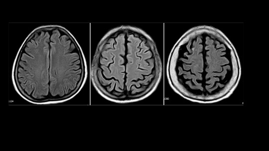 Cortical Atrophy: Symptoms, Causes and Associated Disorders