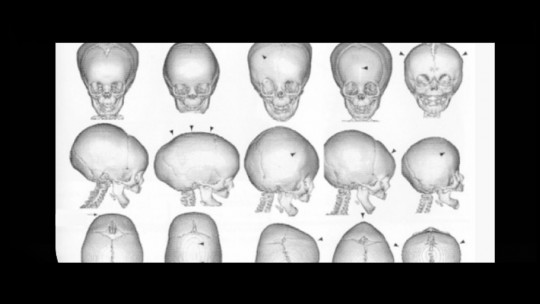 Craniosynostosis: Types, Causes and Treatment