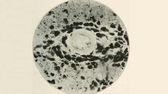 Demyelinating polyneuropathies