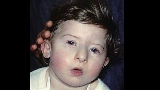 DiGeorge syndrome