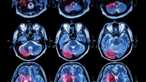 Differences Between Neuropsychology and Neurology