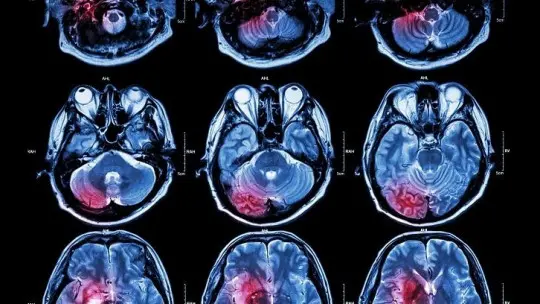 Differences Between Neuropsychology and Neurology