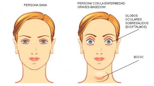 Graves Basedow Disease: Symptoms, Causes and Treatment