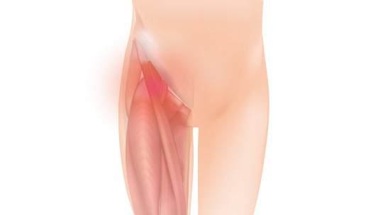 Groin Lump: Possible Causes and Treatments