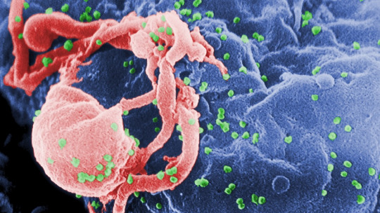 HIV-associated dementia