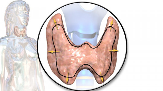 Hashimoto's encephalopathy