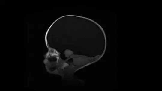 Hydranencephaly: Symptoms, Causes and Treatment Hydranencephaly: Symptoms, Causes and Treatment