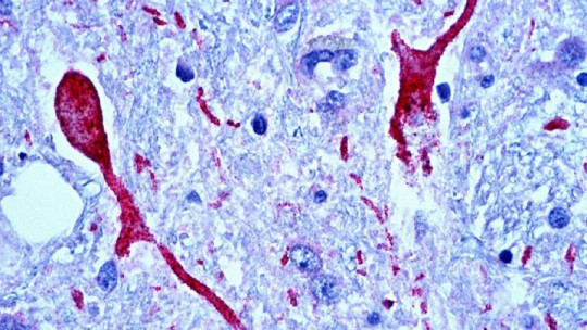 TDP-43 encephalopathy