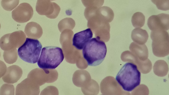 Lymphoblasts