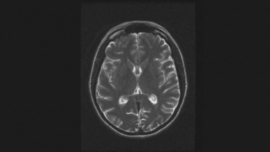 Melas Syndrome: Symptoms, Causes and Treatment