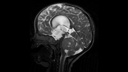 Medulloblastoma