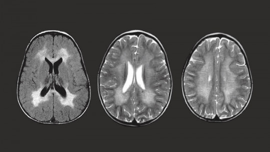 Metachromatic leukodystrophy