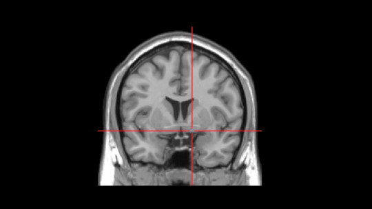 Meynert's basal nucleus