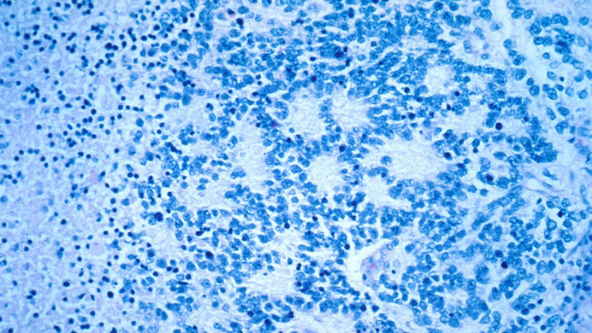 Neuroblastoma.