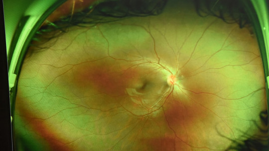 Parts of the retina