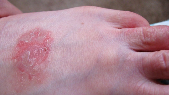 Red Spots on the Skin: 25 Possible Causative Diseases, and