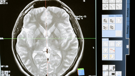 Reptilian Brain: Do We Really Have This Ancestral Structure?