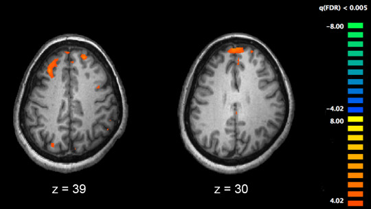 Research Discovers That Schizophrenia is the Manifestation of Eight Genetic