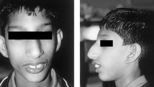 Child with Seckel syndrome.