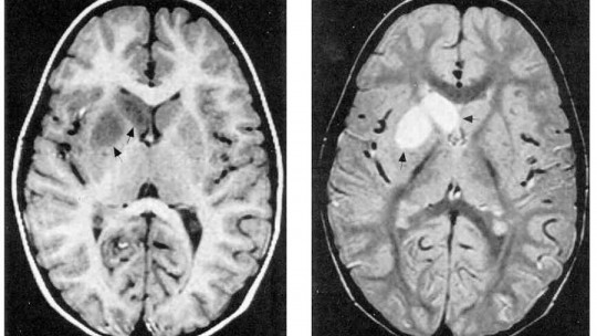 Sydenham Chorea: Causes, Symptoms and Treatment