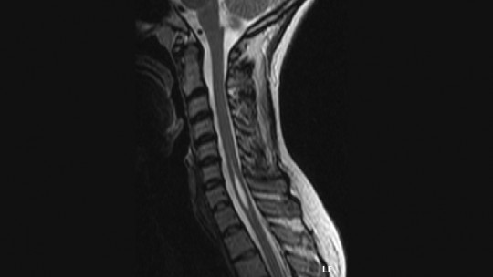 Syringomyelia