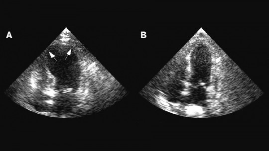 tako-tsubo cardiomyopathy