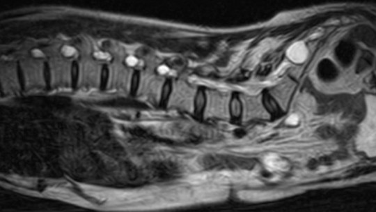 Tarlov cysts